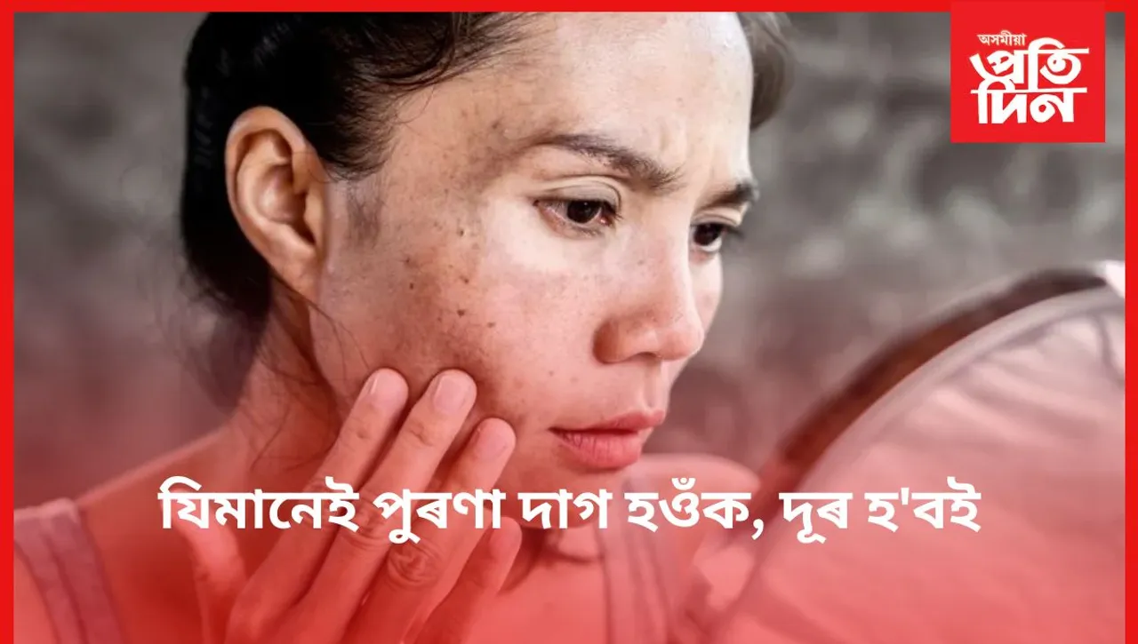 নামী-দামী ক্ৰীম নহয়, ব্যৱহাৰ কৰক এই ঘৰুৱা প্ৰতিকাৰ